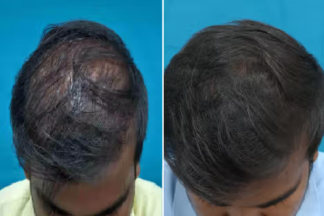 Hair loss in men